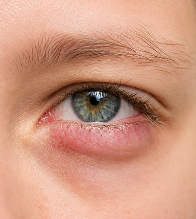 Orbital Disorders