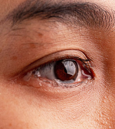 Blocked Tear Ducts and Watery Eyes