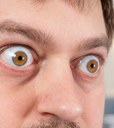 Thyroid Eye Disease