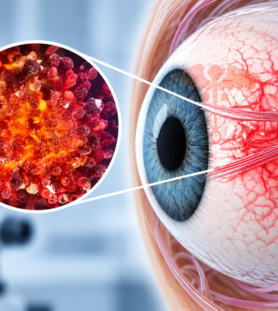 Eye Cancer